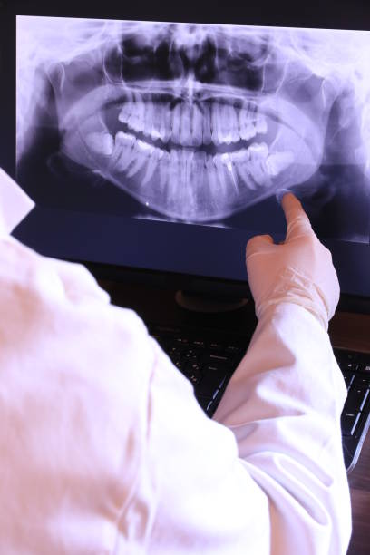 Best Emergency Wisdom Tooth Extraction in Kerhonkson, NY